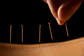 Acupuncture Melbourne