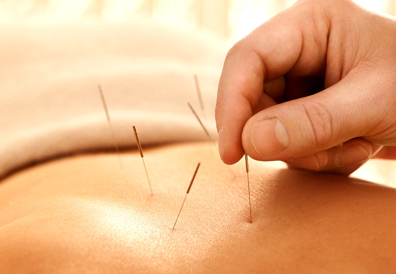 Acupuncture service